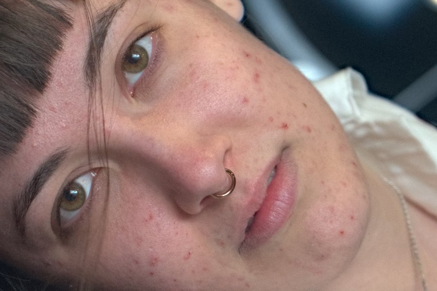 Skin with imperfections